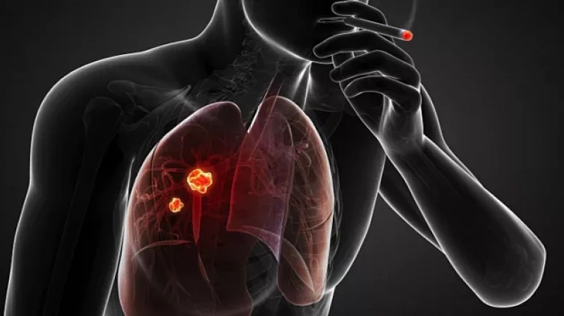Онколог: 1700 жителей Свердловской области заболевают раком лёгких каждый год