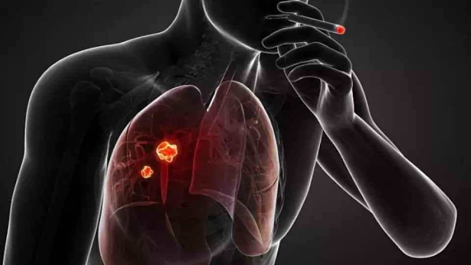 Онколог: 1700 жителей Свердловской области заболевают раком лёгких каждый год