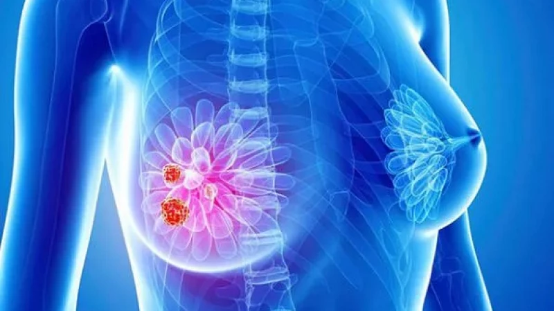 Онколог: «Рак груди – самый распространённый вид онкологии в Свердловской области»