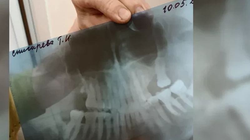 Стоматологи сломали челюсть 85-летней пациентке
