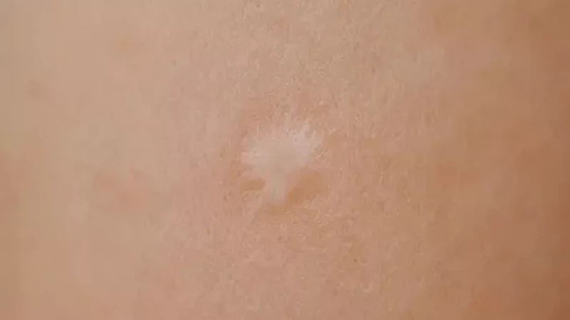 Как защитить ребёнка от туберкулёза?