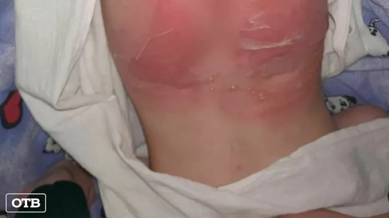 Двухлетняя девочка под присмотром воспитателей получила сильные ожоги в детском саду