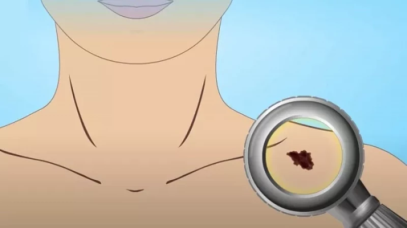 Меланома. Симптомы, диагностика, лечение