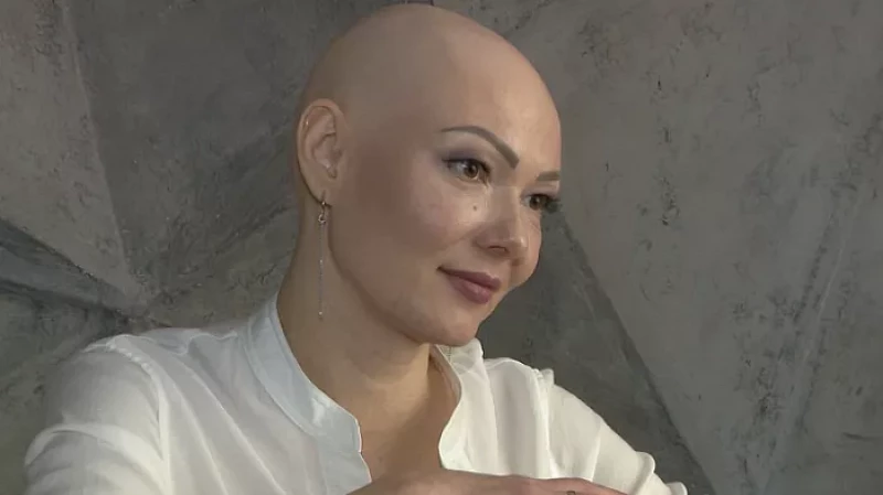 Истории смелых людей с редким заболеванием – алопецией