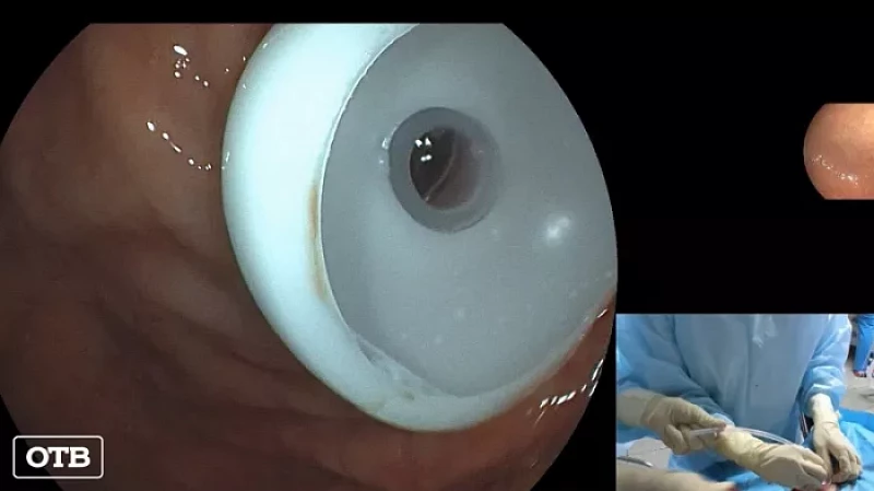 Уральские врачи проводят уникальные операции по установке гастростомы