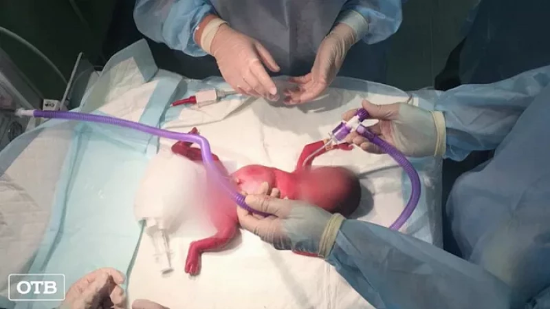 Свердловские врачи прооперировали ребёнка во время его появления на свет