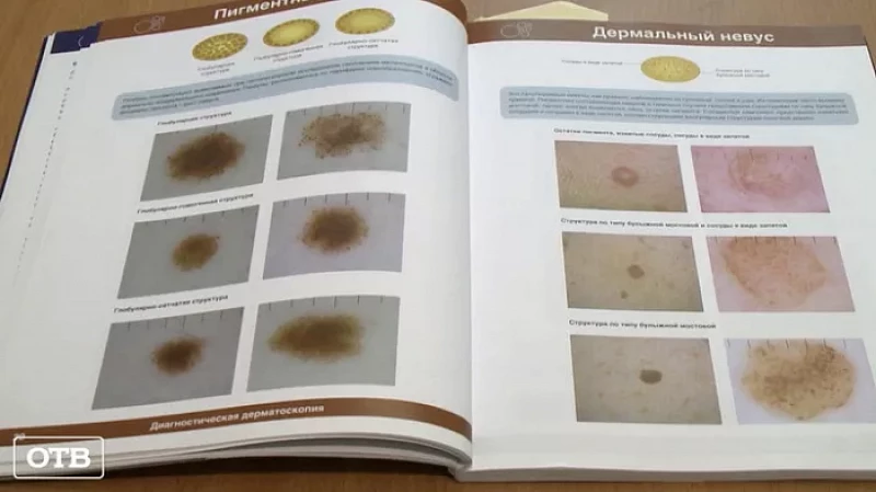 10 апреля в Екатеринбурге пройдут акции по проверке родинок