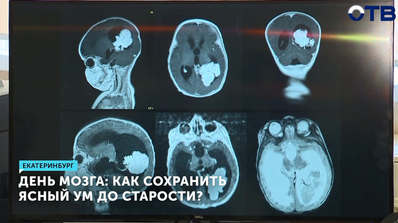 День мозга: как сохранить ясный ум до старости?