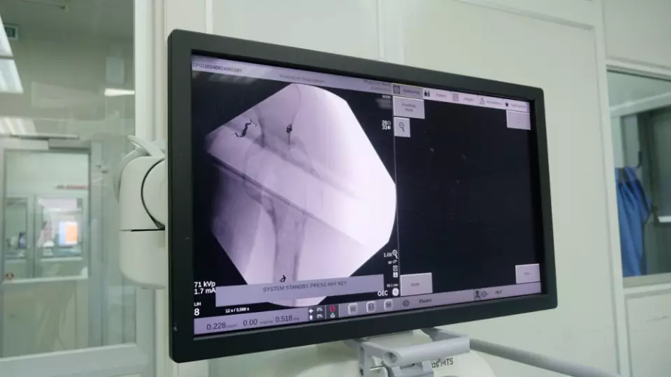 На Урале врачи установили 3D-имплант и предотвратили ампутацию руки пациента