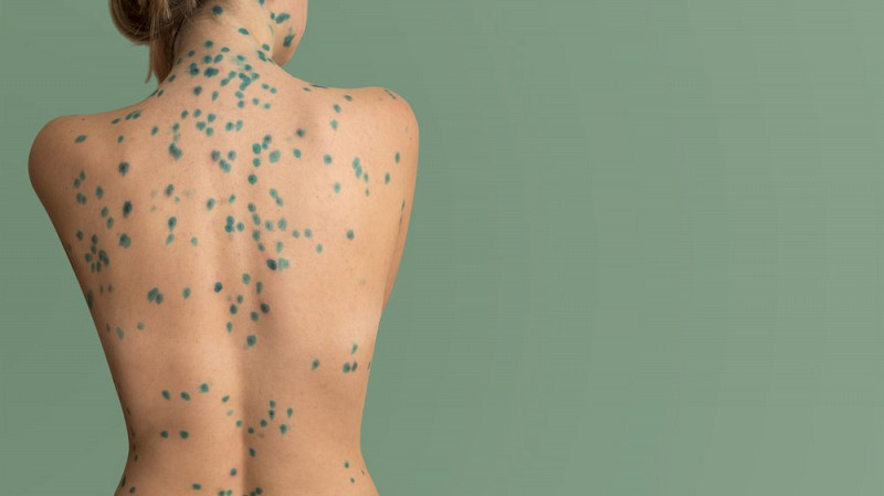 В Екатеринбурге пятеро индийских студентов заразились ветряной оспой