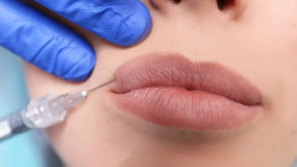 Россиянки массово отказываются от филлеров