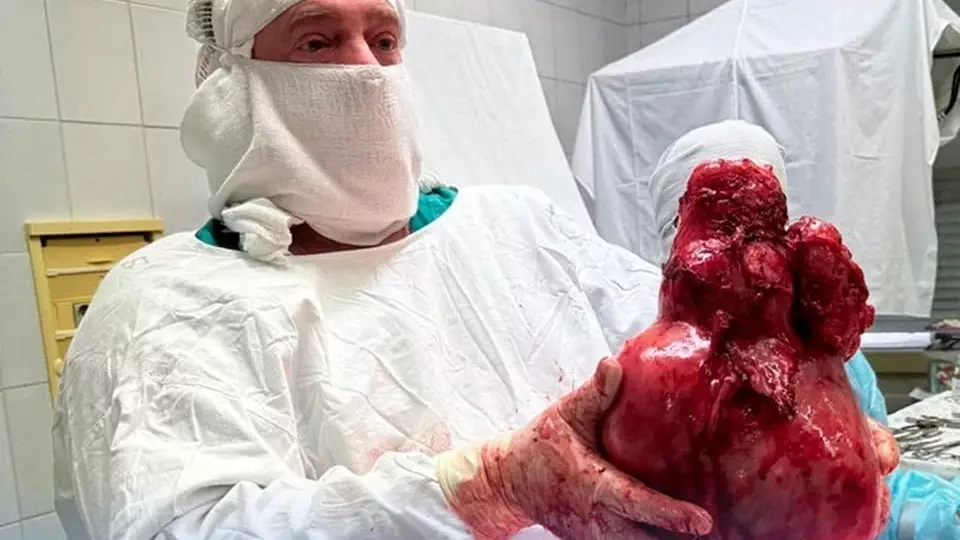 Врачи Сургутской больницы успешно удалили миому весом 5 кг