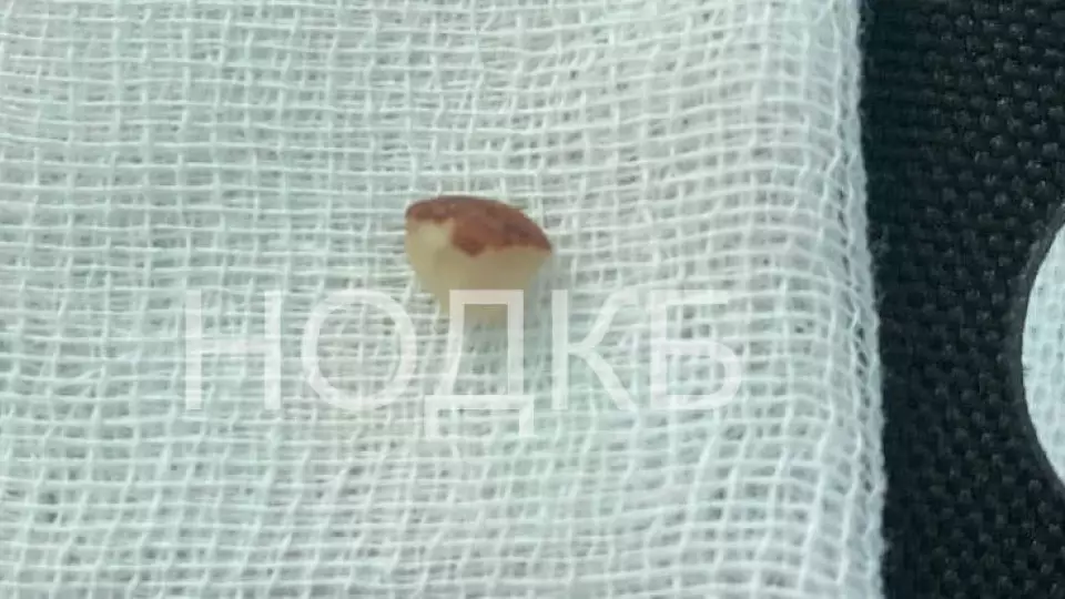 Врачи спасли ребенка, подавившегося орехом