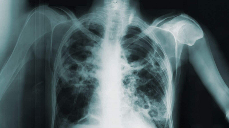 Три студента Первоуральского политеха заболели туберкулезом