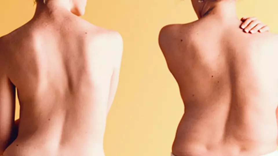 Врач-травматолог предупреждает о рисках сколиоза для здоровья