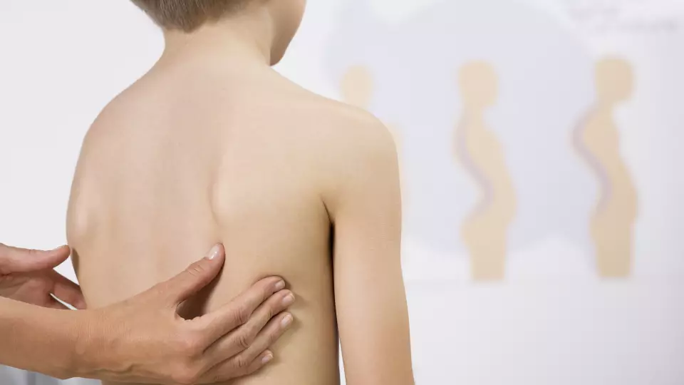 Врач объяснил, в чем разница между сутулостью и сколиозом