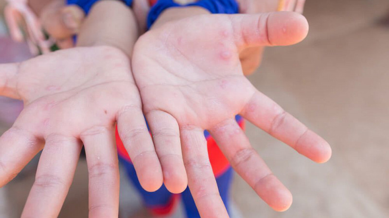 Меры против энтеровируса усилят в свердловских школах и детсадах