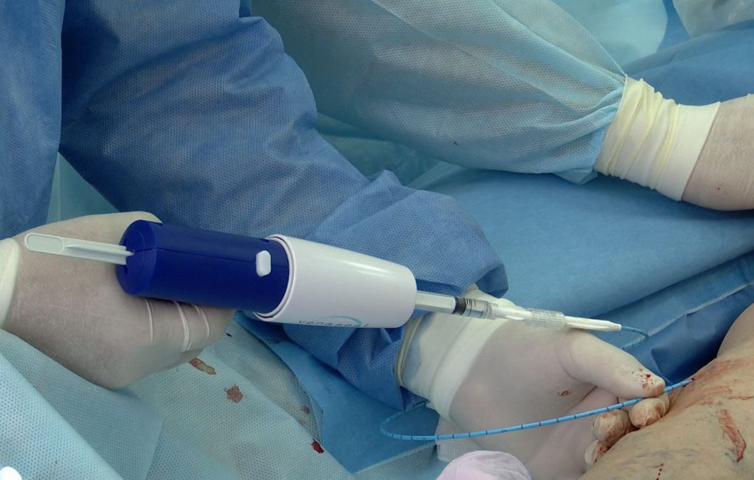 В Кемерове впервые вылечили варикоз с помощью клеевого пистолета