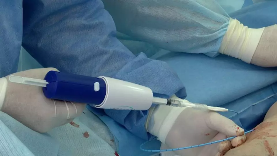 В Кемерове впервые вылечили варикоз с помощью клеевого пистолета