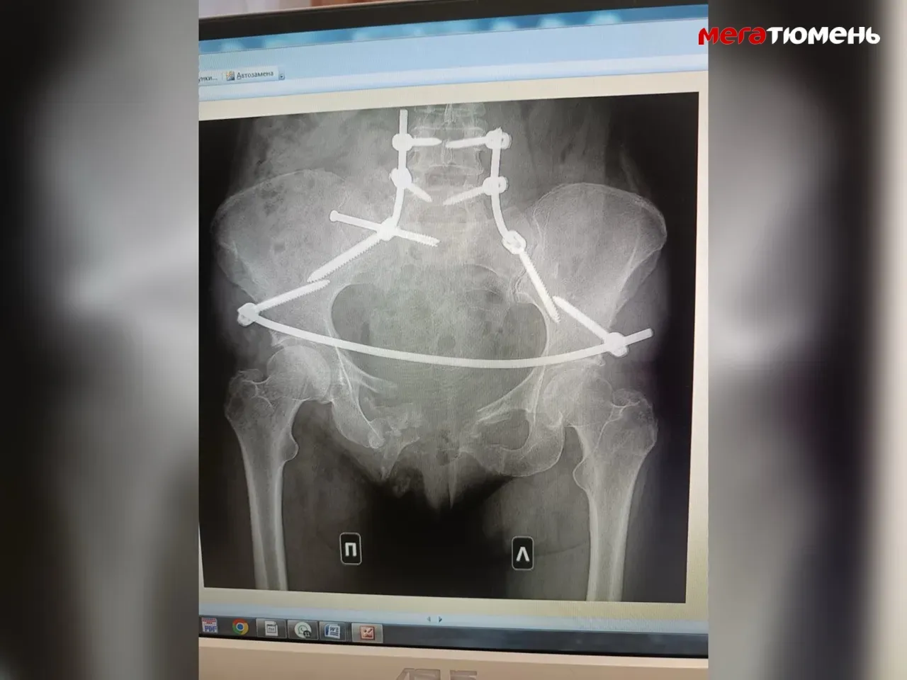 Тюменка, которую переехал сосед, борется за справедливость