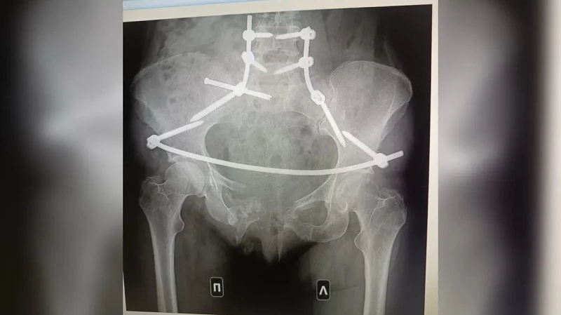Тюменка, которую переехал сосед, борется за справедливость