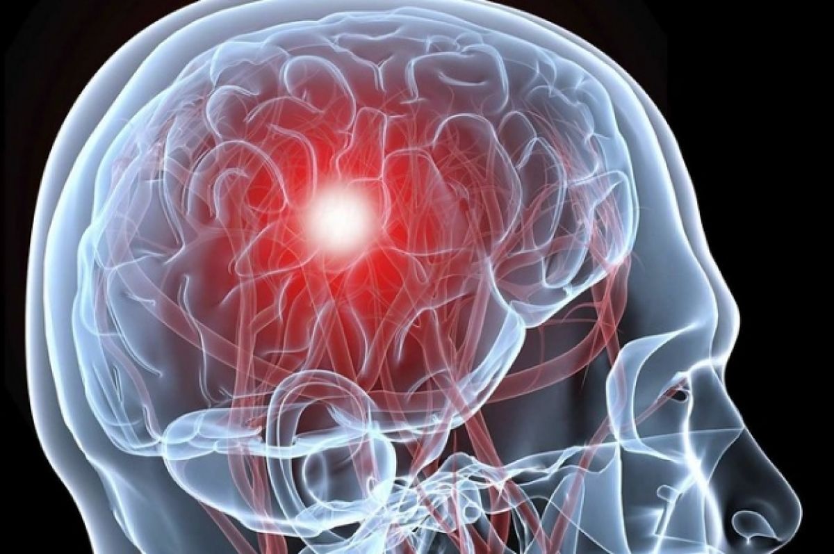 Как распознать инсульт и спасти жизнь?