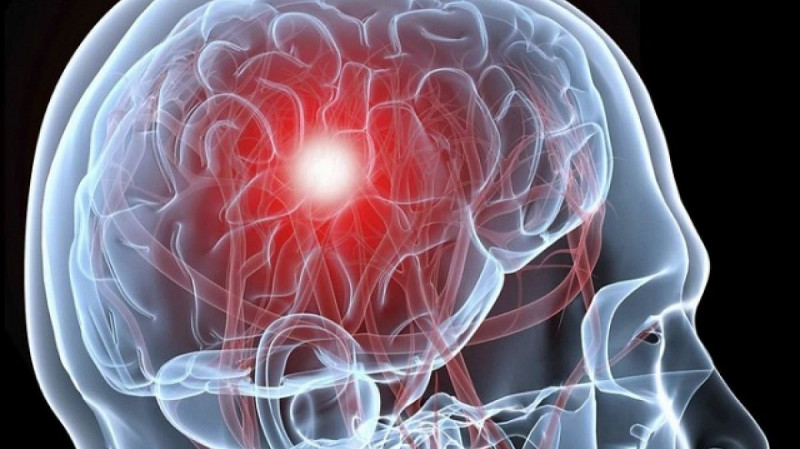 Как распознать инсульт и спасти жизнь?
