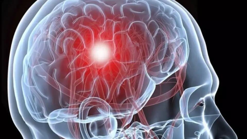 Как распознать инсульт и спасти жизнь?