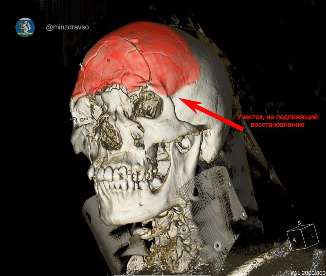 Пациента с раздробленным после ДТП черепом спасли врачи Нижнего Тагила