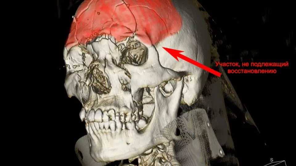 Пациента с раздробленным после ДТП черепом спасли врачи Нижнего Тагила