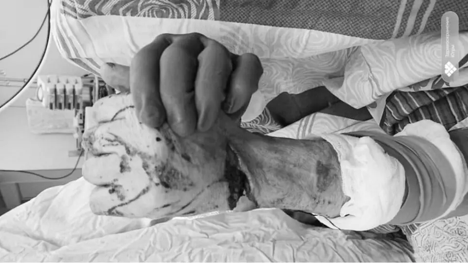 Врачи пришили кисть пенсионеру после травмы болгаркой