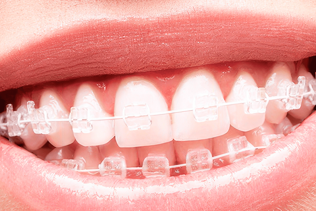 Врач рассказала всё о брекетах: от сроков ношения до стоимости