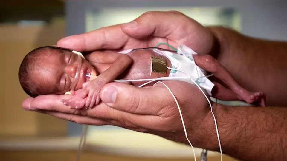 В Индии спасли жизнь девочки, родившейся с весом 350 грамм