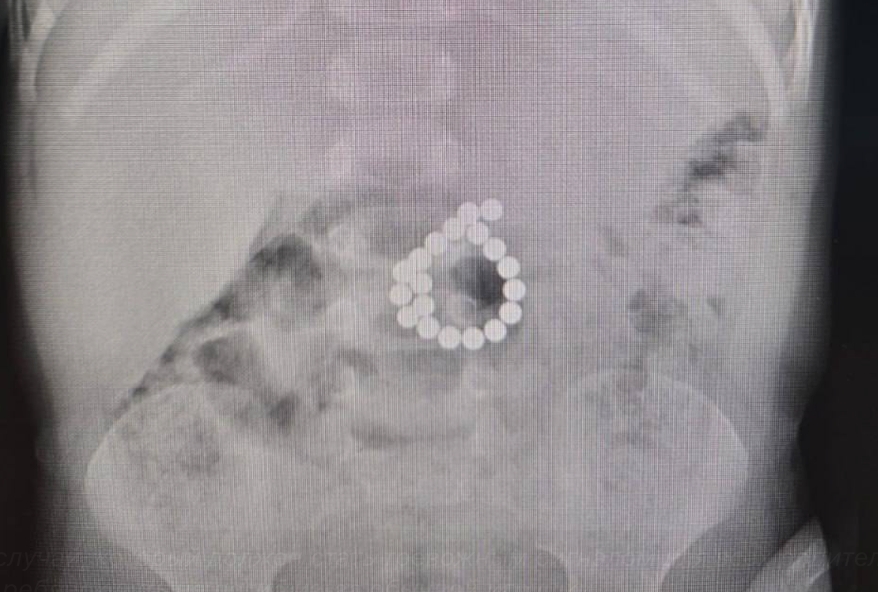 В Югре двухлетний ребенок проглотил 19 магнитов из игрушки и чуть не умер