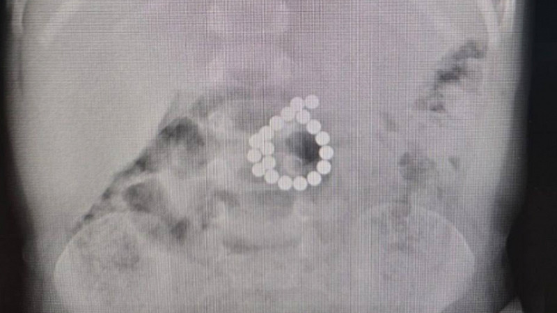 В Югре двухлетний ребенок проглотил 19 магнитов из игрушки и чуть не умер