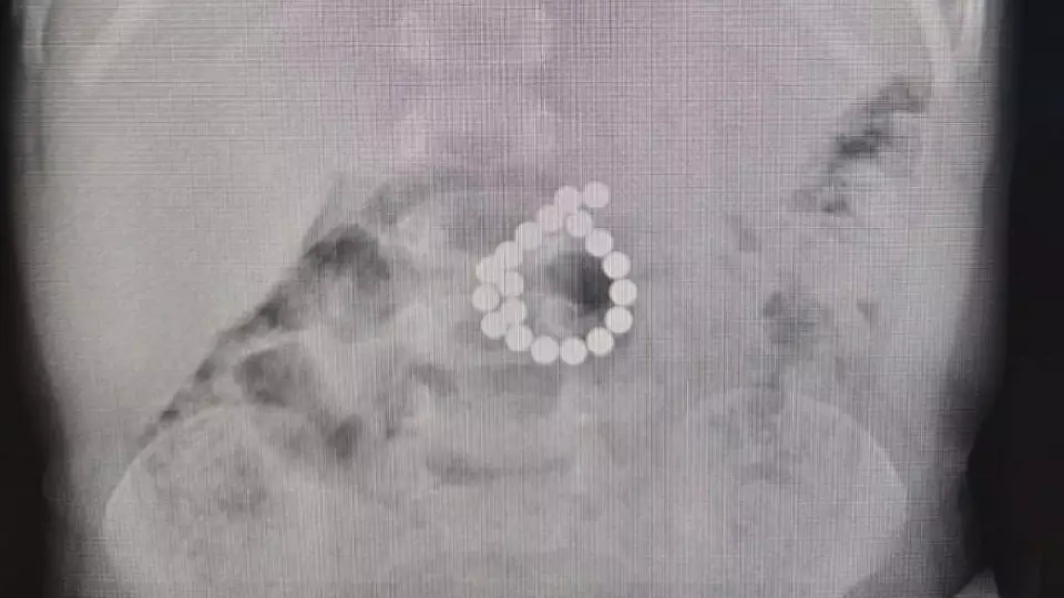 В Югре двухлетний ребенок проглотил 19 магнитов из игрушки и чуть не умер