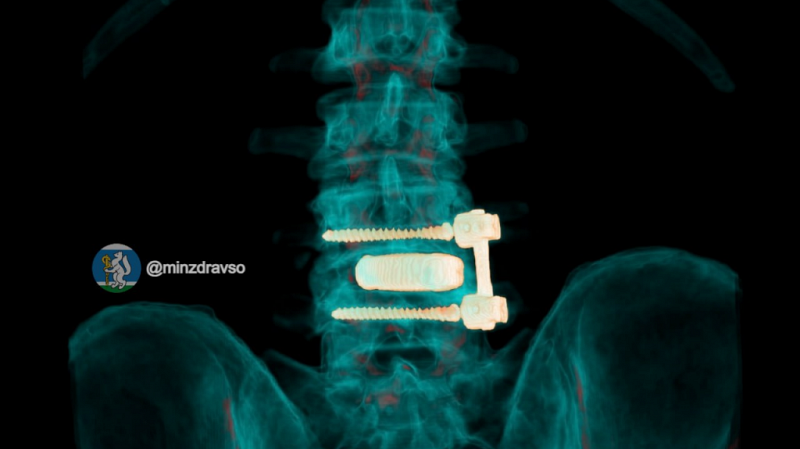 Нейрохирурги восстановили позвоночник 52-летнего водителя скорой помощи