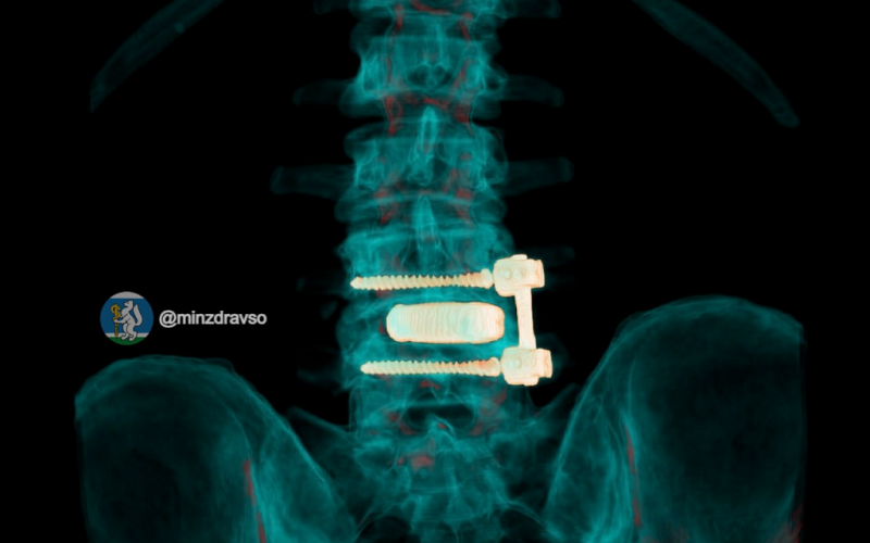 Нейрохирурги восстановили позвоночник 52-летнего водителя скорой помощи