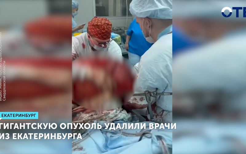 Гигантскую опухоль удалили врачи из Екатеринбурга