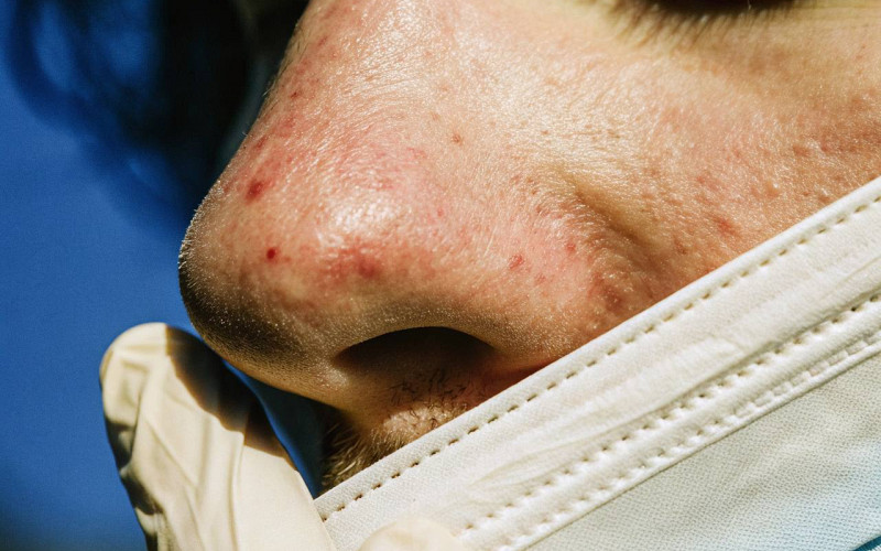 Потеря обоняния влияет на жизнь сильнее приступов удушья — аллерголог