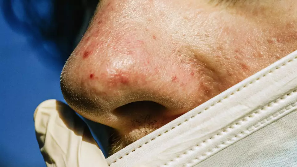 Потеря обоняния влияет на жизнь сильнее приступов удушья — аллерголог