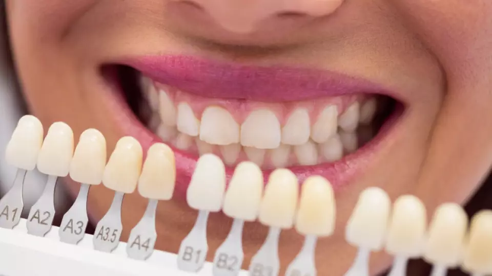 Чем опасны пломбы и отбеливание с маркетплейсов