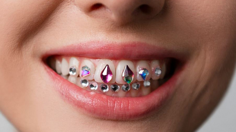 Скайсы и грилзы, установленные дома, могут привести к кариесу