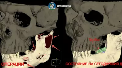 Челюсть свердловчанина спасли от разъедавшей её кисты