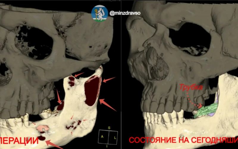 Челюсть свердловчанина спасли от разъедавшей её кисты