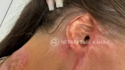 «Ухо приросло к голове, кисть почти не двигается»: пострадавшая от нападения с «кислотой» рассказала о восстановлении