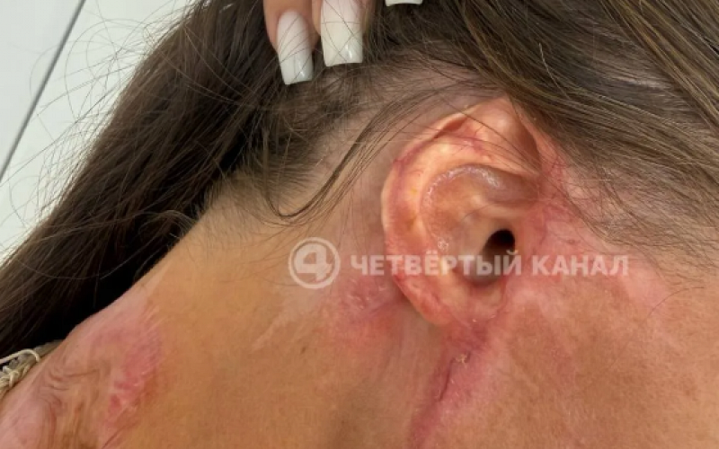 «Ухо приросло к голове, кисть почти не двигается»: пострадавшая от нападения с «кислотой» рассказала о восстановлении