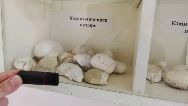 Свердловские врачи удаляют камни в почках за 30 минут без разрезов с помощью нового российского лазера