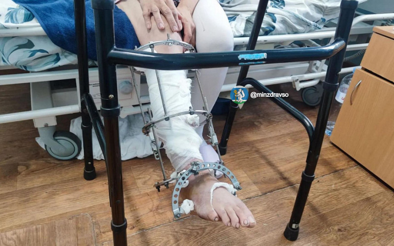 В Алапаевске врачи пришили женщине почти оторванную мотоблоком ступню