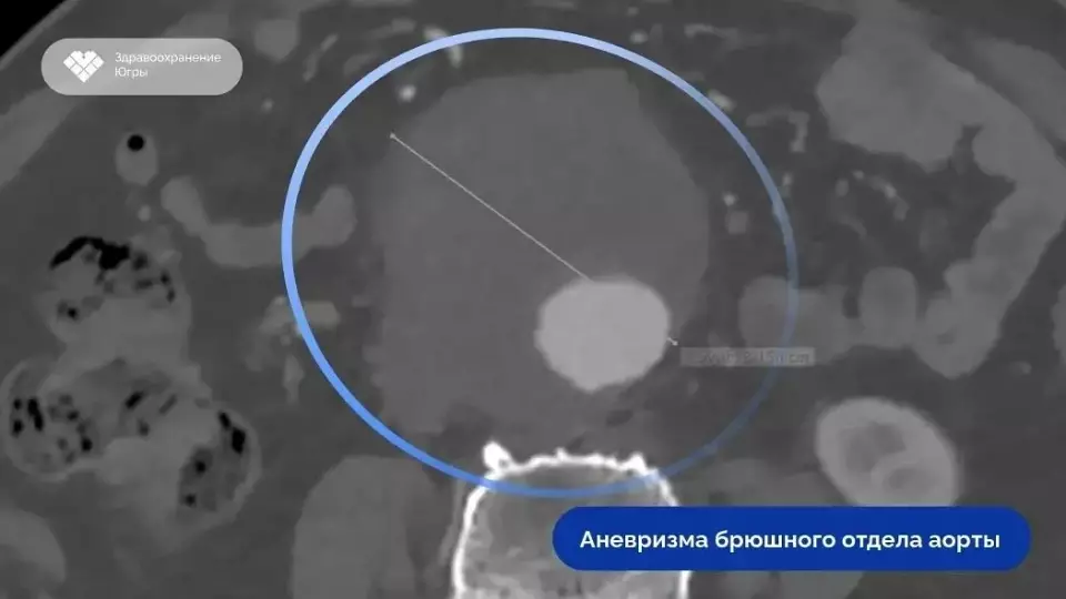 Врачи восстановили аорту 75-летнего пациента из пяти компонентов протеза